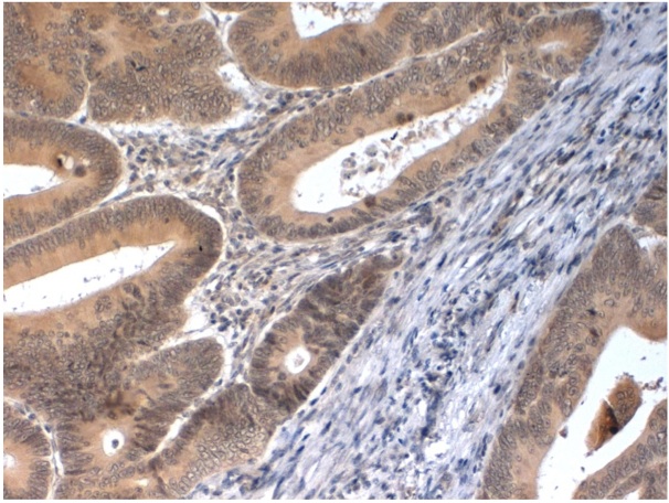 Immunohistochemical staining of FFPE human colon carcinoma tissue using PINK-1 (CT) antibody (Cat. No. X2760P).  Antibody used at 1 µg/ml and visualized using DAB.  Pathologists Comments: Cytoplasmic staining of mucous cells.